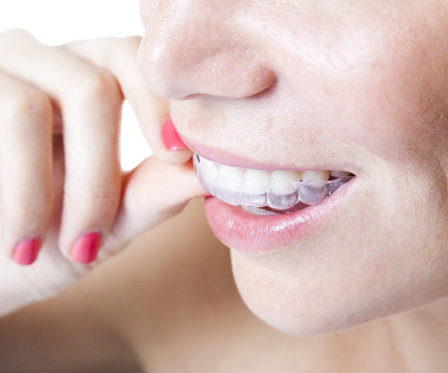 Choice Dental Care is your choice for Invisalign Clear Aligners in Silver Springs, MD